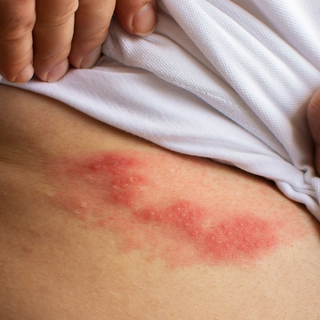 Eine mit G&uuml;rtelrose betroffene Stelle am K&ouml;rper