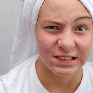 Eine Teenagerin mit Pickeln schaut kritisch in die Kamera.