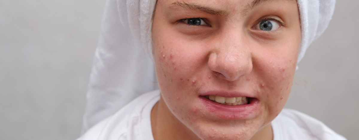 Eine Teenagerin mit Pickeln schaut kritisch in die Kamera.